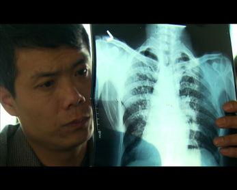 尘肺病视频,揭示尘肺危害与预防之道